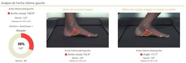 PIED PLAT ET SES TRAITEMENTS semelles orthop diques chirurgie